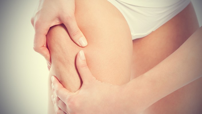 cellulite